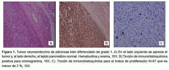 Tumor neuroendocrino de páncreas