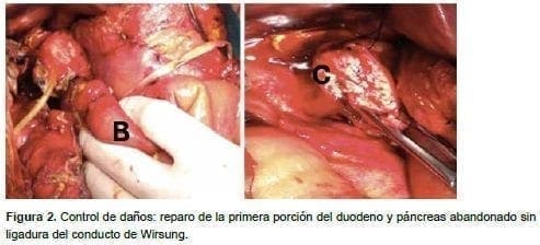 Ligadura del conducto de Wirsung Ligadura del conducto de Wirsung