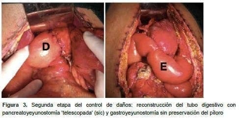 Reconstrucción del tubo digestivo con pancreatoyeyunostomía Reconstrucción del tubo digestivo con pancreatoyeyunostomía