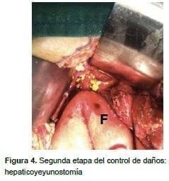 Segunda etapa del control hepaticoyeyunostomía