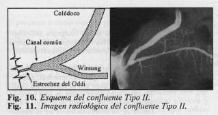 Esquema de patología del confluente biliopancreatico Esquema de patología del confluente biliopancreatico