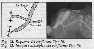 Patología del confluente biliopancreatico Patología del confluente biliopancreatico