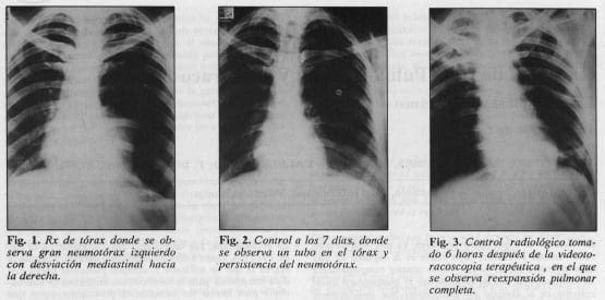 Ligadura de Bula Pulmonar