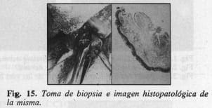 Patología del confluente biliopancreatico, biopsia Patología del confluente biliopancreatico, biopsia