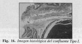 Patología del confluente biliopancreatico Patología del confluente biliopancreatico