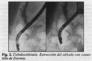 Coledocolitiasis
