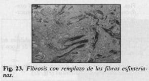 Fibrosis con remplazo de las fibras esfinterianas Fibrosis con remplazo de las fibras esfinterianas
