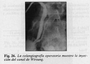 Canal de Wirsung Canal de Wirsung