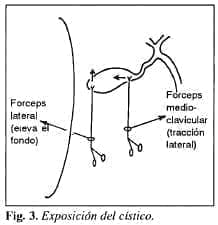 Exposición del cístico