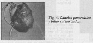 Canales pancreático y biliar cateterizados Canales pancreático y biliar cateterizados
