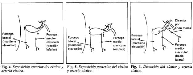 Cístico y arteria cística