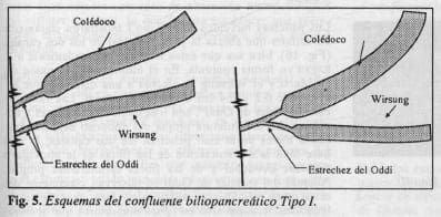 Esquema confluente biliopancreático Tipo l Esquema confluente biliopancreático Tipo l