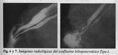 Confluente biliopancreático Tipo l Confluente biliopancreático Tipo l