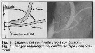 Esquema del confluente Tipo I con Santorini Esquema del confluente Tipo I con Santorini