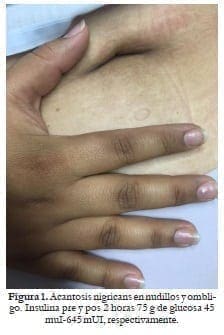 Acantosis nigricans en nudillos y ombligo