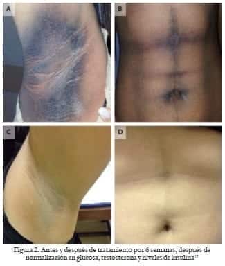 Normalización en glucosa, testosterona y niveles de insulina Normalización en glucosa, testosterona y niveles de insulina