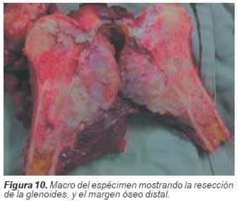 Resección de la glenoides