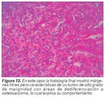 Malignidad con áreas de dediferenciación a osteosarcoma Malignidad con áreas de dediferenciación a osteosarcoma
