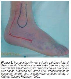 Vascularización del colgajo calcáneo lateral Vascularización del colgajo calcáneo lateral