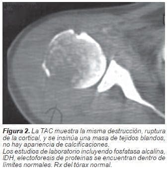 Ruptura de la cortical Ruptura de la cortical