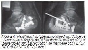 Ángulo de Böhler derecho Ángulo de Böhler derecho
