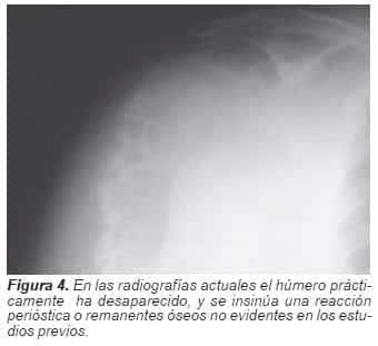 Radiografía muestra húmero prácticamente desaparecido Radiografía muestra húmero prácticamente desaparecido