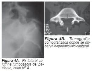 Espondilolisis bilateral Espondilolisis bilateral