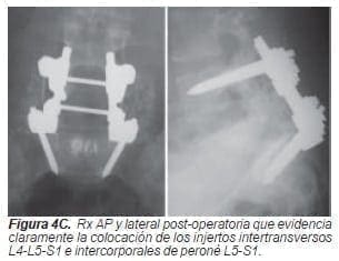 Injertos intertransversos L4-L5-S1 Injertos intertransversos L4-L5-S1