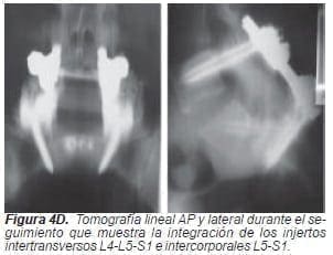 Injertos intertransversos L4-L5-S1 Injertos intertransversos L4-L5-S1