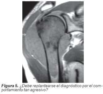 Lesión tumoral con masa de tejidos blandos