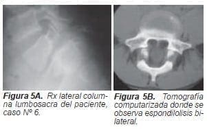 Espondilolisis bilateral Espondilolisis bilateral