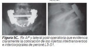 Injertos intertransversos e intercorporales de peroné Injertos intertransversos e intercorporales de peroné