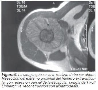 Cirugía de Tikoff Linbergh