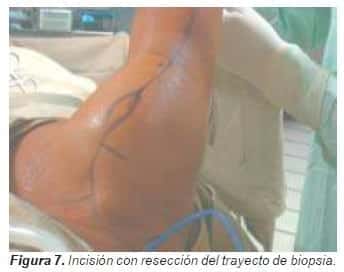 Incisión con resección del trayecto de biopsia