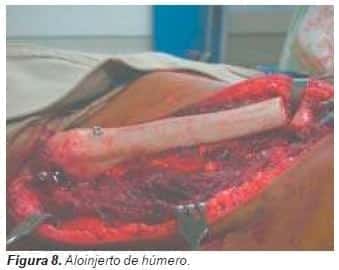 Aloinjerto de húmero