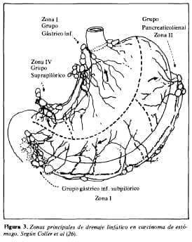 Drenaje linfático en carcinoma de estómago