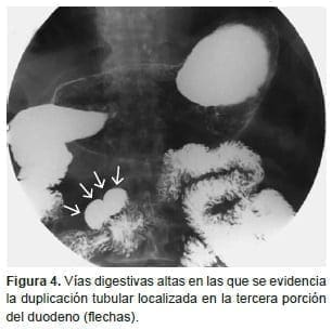 Vías digestivas altas en las que se evidencia la duplicación tubular