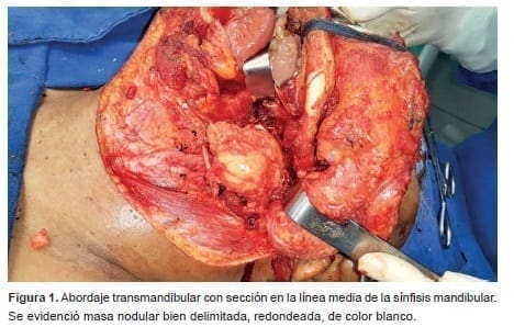 Condroma del espacio parafaríngeo, línea media de la sínfisis mandibular Condroma del espacio parafaríngeo, línea media de la sínfisis mandibular