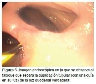 Tabique que separa la duplicación tubular