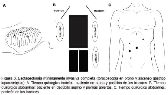 Toracoscopia en prono y ascenso gástrico laparoscópico