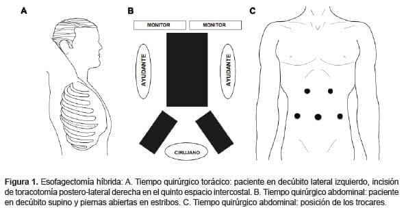 Esofagectomía híbrida