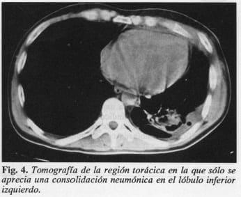 Drenaje Quirúrgico Cervicotorácico, lóbulo inferior izquierdo Drenaje Quirúrgico Cervicotorácico, lóbulo inferior izquierdo