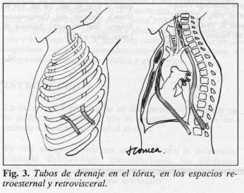 Tubos de drenaje en el tórax Tubos de drenaje en el tórax