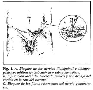 Bloqueo de los nervios ilioinguinal e iliohipogástrico
