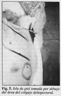 Colgajo deltopectoral - Colgajo Musculocutáneo