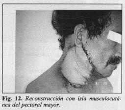 Reconstrucción con isla musculocutánea del pectoral mayor - Colgajo Musculocutáneo