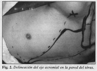 Delineación del eje acromial en la pared del tórax - Colgajo Musculocutáneo