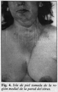 Isla de piel de la remusculocutáneo del pectoral mayor - Colgajo Musculocutáneo