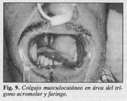 Colgajo musculocutáneo en área del trígono acromolar - Colgajo Musculocutáneo