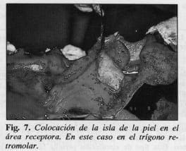 Colocación de piel en el trígono retromolar - Colgajo Musculocutáneo